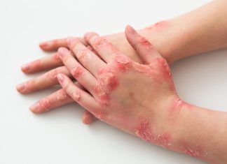 बालबालिकालाई छालाको एलर्जी, कारण अनेक skin-alergies